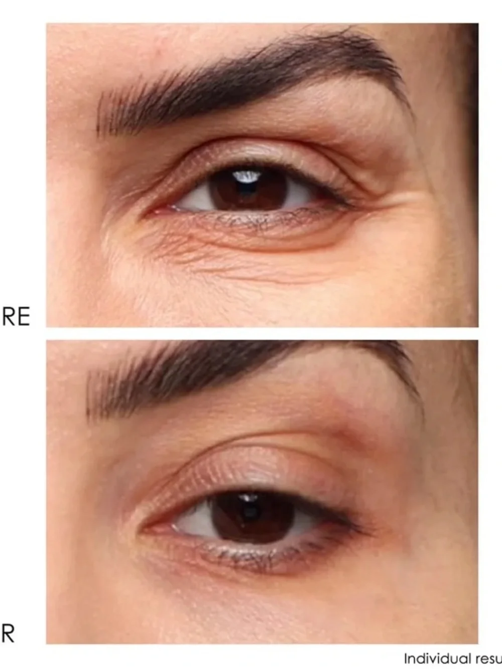 Dermelect Revitalite Eyelid & Dark Circle Corrector